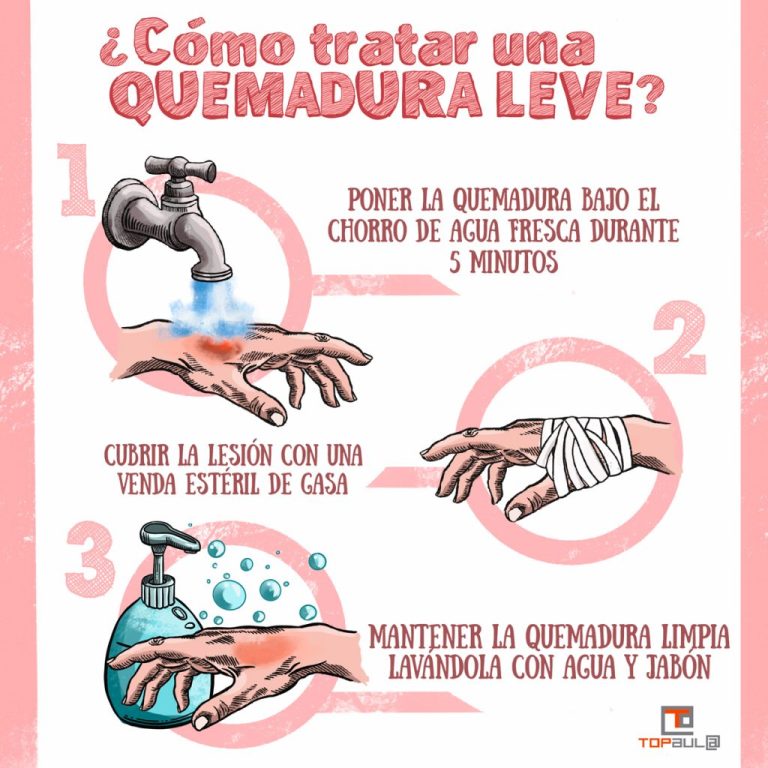 Primeros auxilios para quemaduras de primer grado: actúa rápido y ...