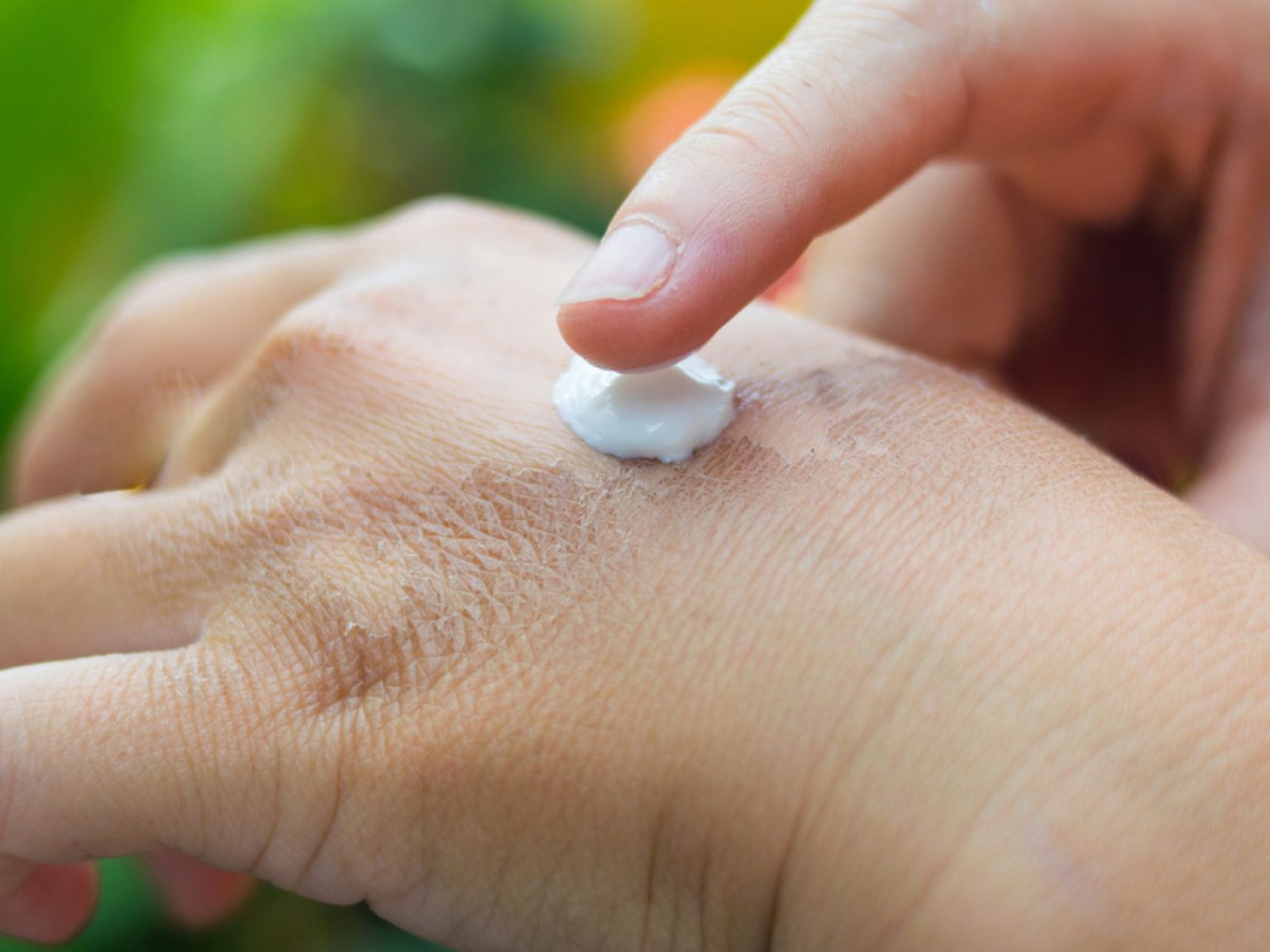 Tratamiento efectivo para quemaduras de segundo grado: recupera tu piel ...